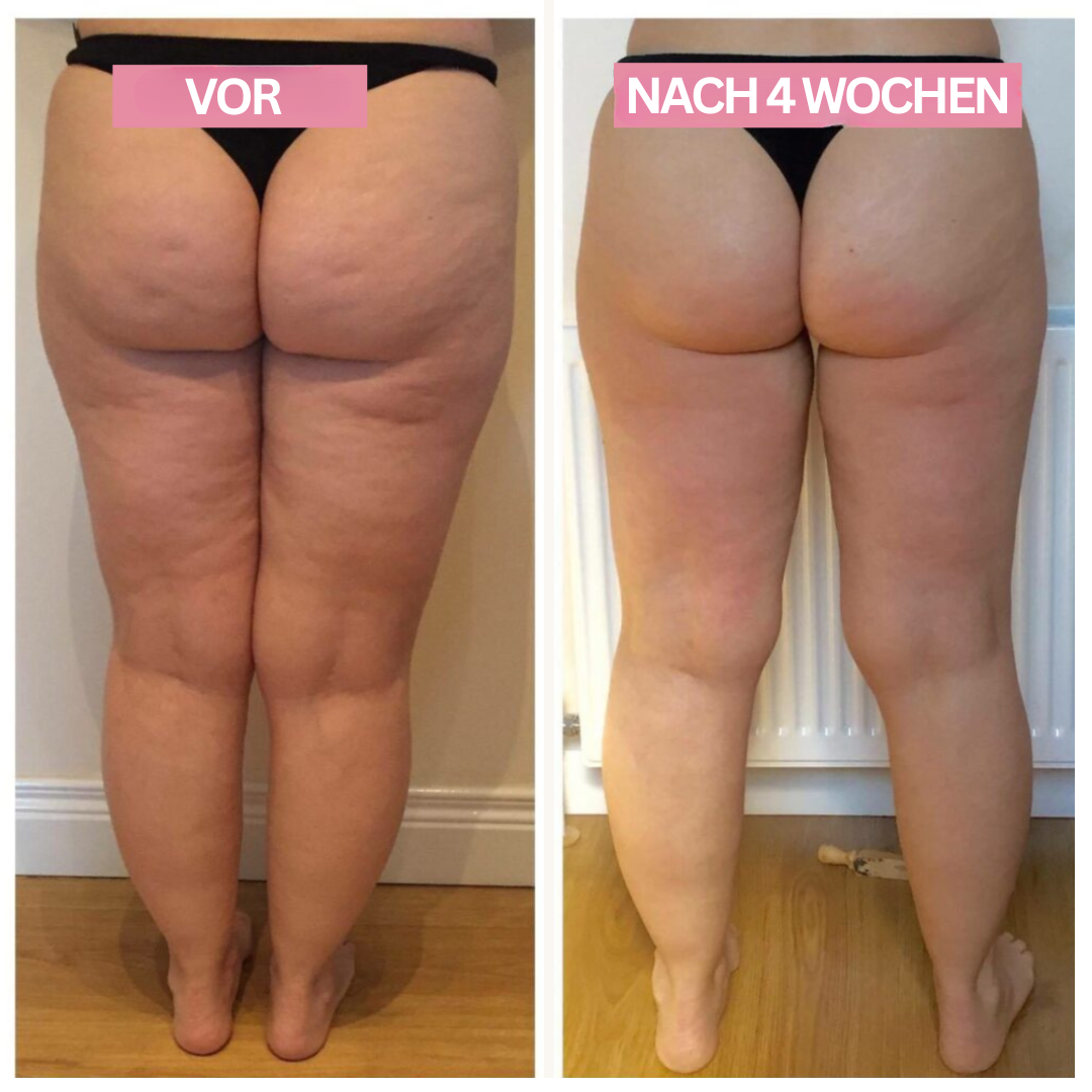 Modernes Anti-Cellulite-Gerät für Beine & Po. Mit Cupping-Massage & Infrarot gegen Cellulite.