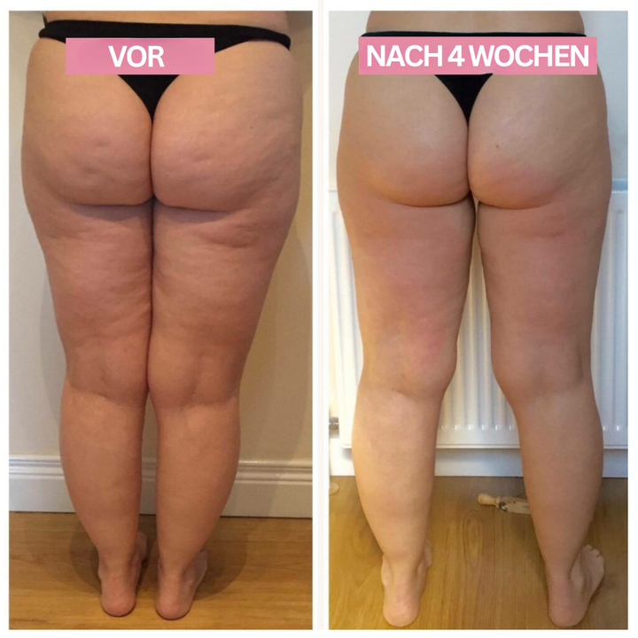 Modernes Anti-Cellulite-Gerät für Beine & Po. Mit Cupping-Massage & Infrarot gegen Cellulite.