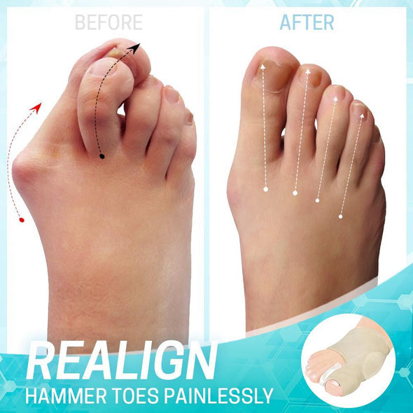 Set aus Ballenzeh-Korrekturhülsen für langanhaltende Fußpflege und Unterstützung bei Hallux Valgus.