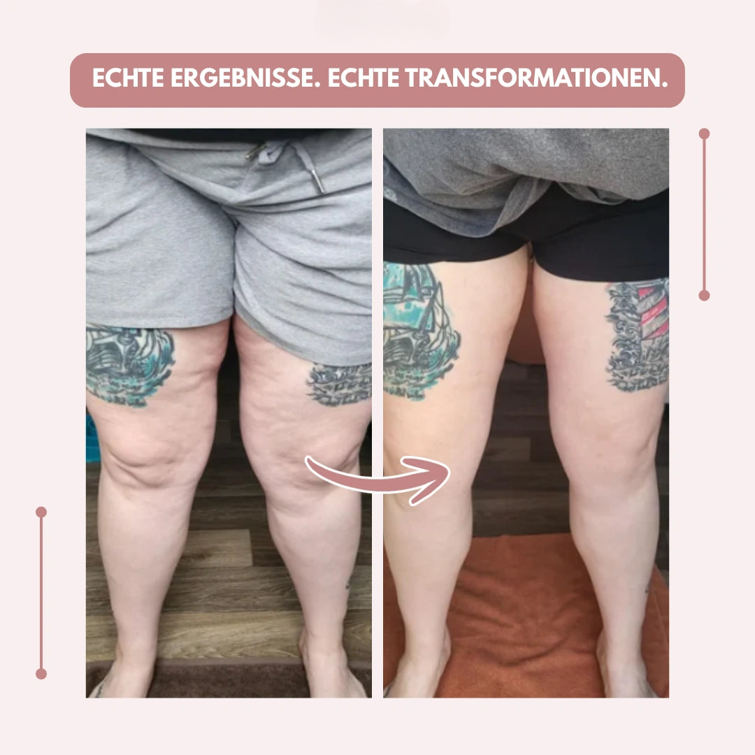Damen Sport & Alltag Kompressionsleggings, hohe Taille, gezielte Unterstützung bei Lipödem.