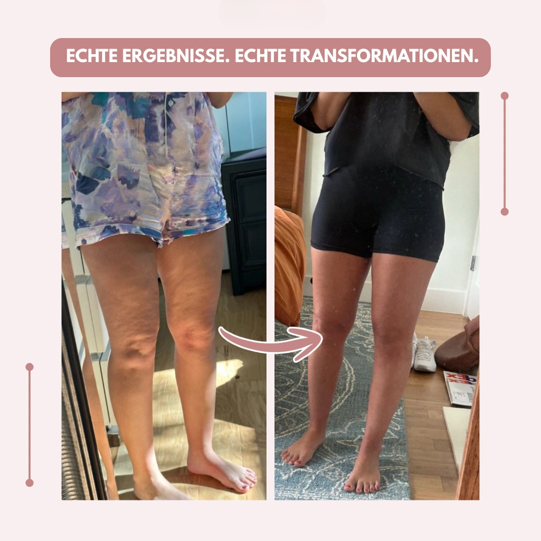 Weiche Kompressionsleggings für Damen, hoher Bund, verbessert die Durchblutung bei Lipödem.