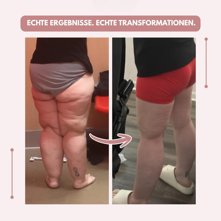 Schwarze Damen Kompressionsleggings, hohe Taille, ideal bei Lipödem. Shaping & Wohlbefinden.