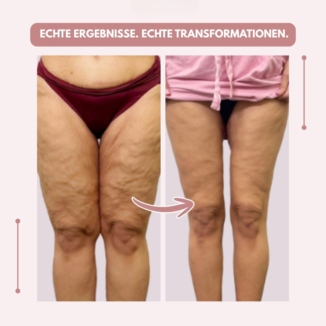 Moderne Damen Leggings mit starker Kompression und hoher Taille, speziell für Lipödem.