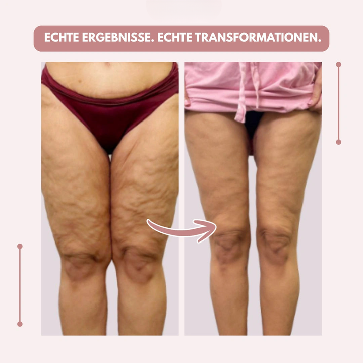 Moderne Damen Leggings mit starker Kompression und hoher Taille, speziell für Lipödem.