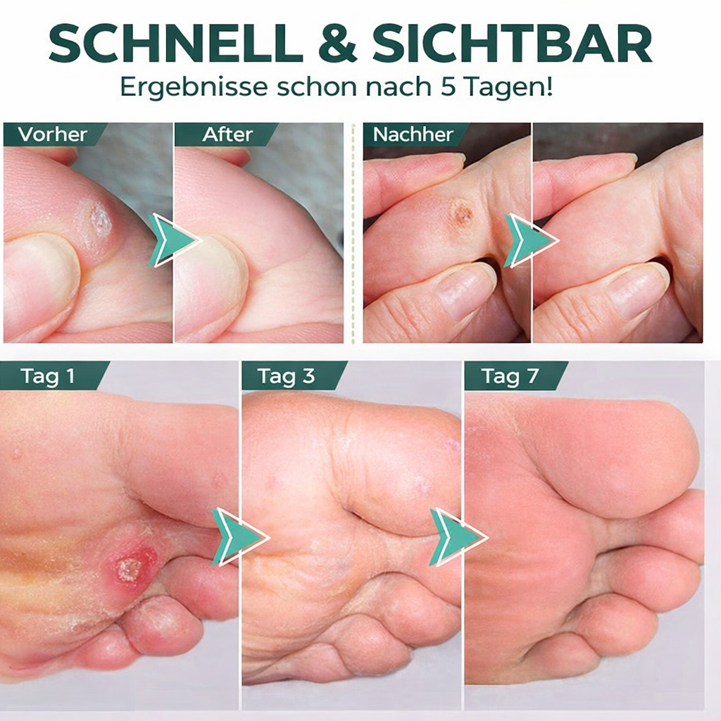 Präzise Anwendung des Hornhautentferner Gels auf Füßen für effektive, schmerzfreie Pediküre & Hautpflege.