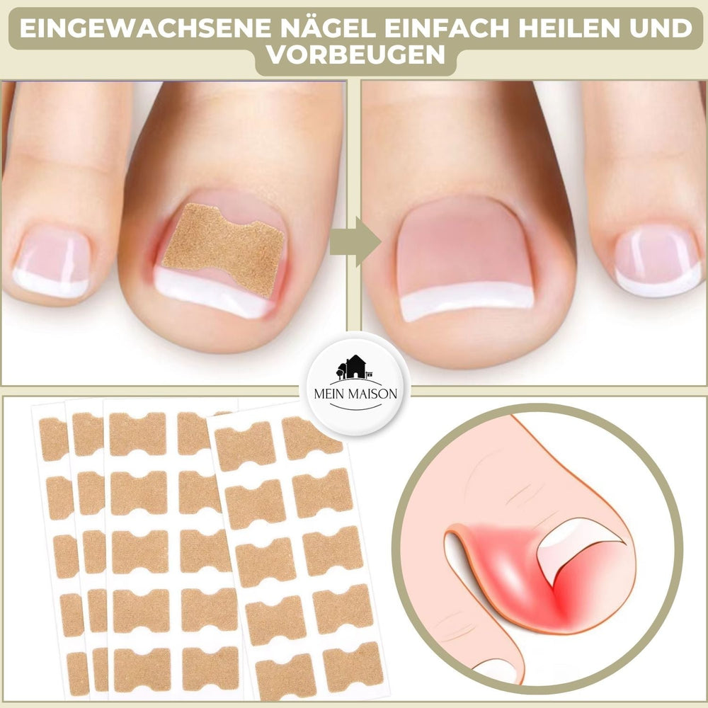 Nahaufnahme eines Zehs mit FixaNail Pflaster zur sofortigen Korrektur und Schmerzlinderung bei eingewachsenen Nägeln.