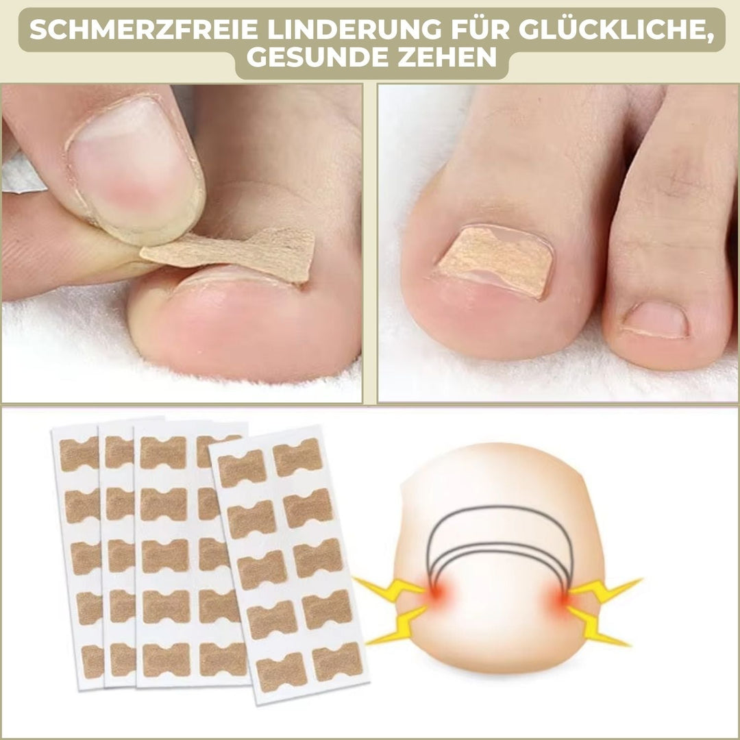 FixaNail Set für gesunde Nägel: Nagelreparatur & effektive Korrektur von eingewachsenen Zehennägeln.