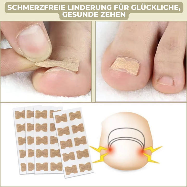 FixaNail Set für gesunde Nägel: Nagelreparatur & effektive Korrektur von eingewachsenen Zehennägeln.