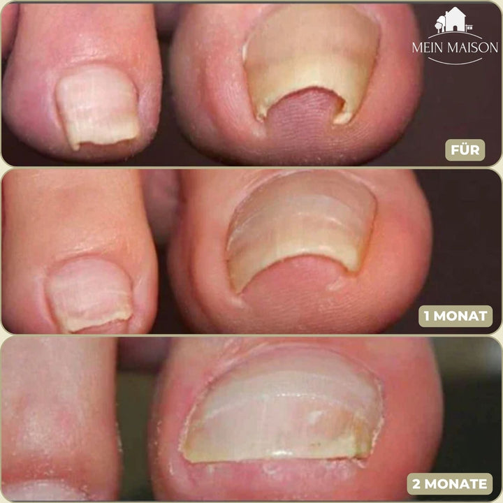 Schmerzfreie Hilfe bei Nagelproblemen: FixaNail Nagelpflaster für schnelle Linderung eingewachsener Nägel.