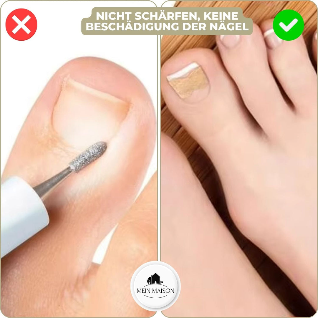 Vorher-Nachher-Effekt mit FixaNail: Korrektur eingewachsener Nägel & Förderung gesunder Fußpflege.