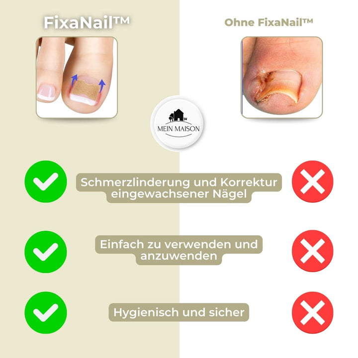 FixaNail: Spezielle Nagelhilfe für Pediküre und Nagelgesundheit; korrigiert sanft eingewachsene Nägel.