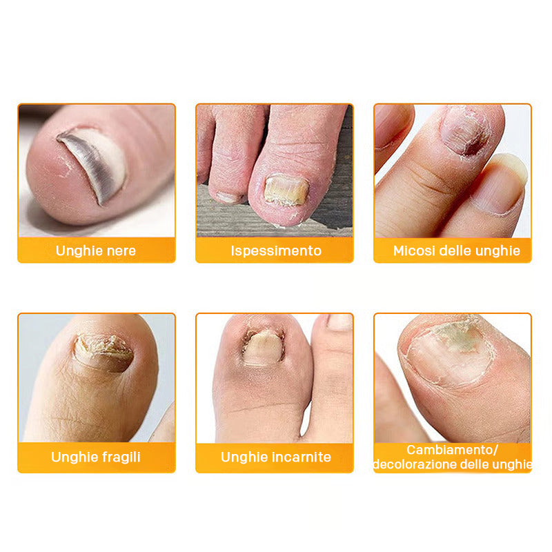 Schöne, pilzfreie Nägel: FungoStop Pflaster für umfassende Nagelpflege und -schutz.