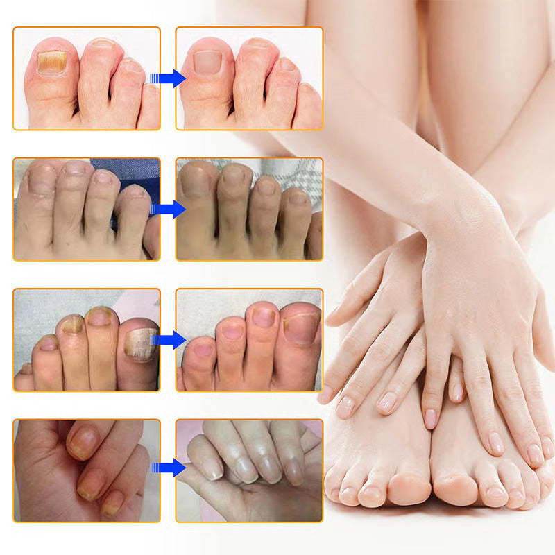 Über Nacht gesunde Nägel: FungoStop Pflaster für effektive Nagelpilztherapie.