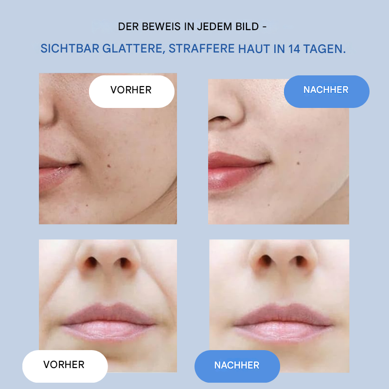 Diskrete Lifting-Streifen für jugendliche Haut und sichtbare Faltenreduktion.