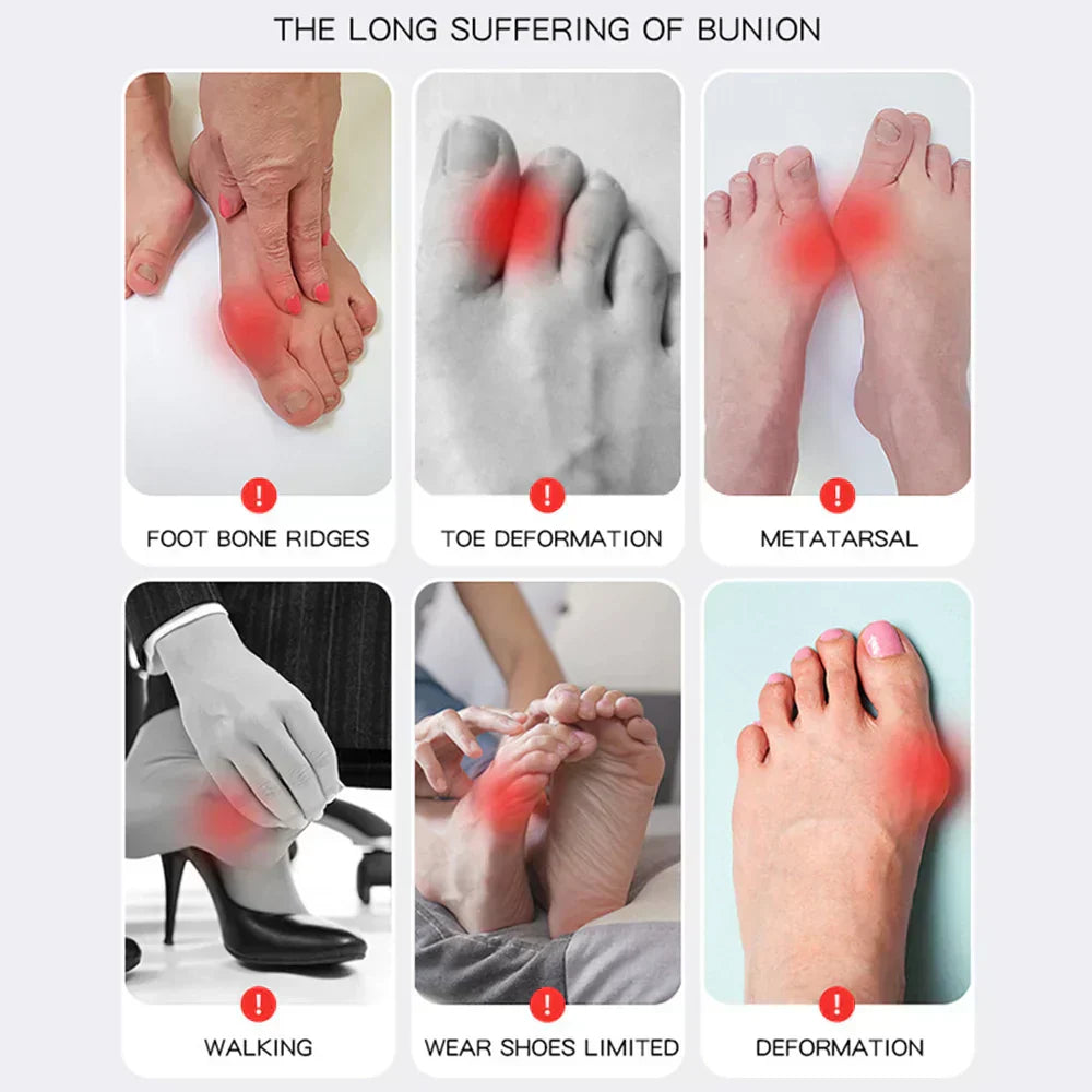 Verstellbare Hallux Valgus Fußschiene für individuelle Zehenkorrektur; optimale Passform & Halt.