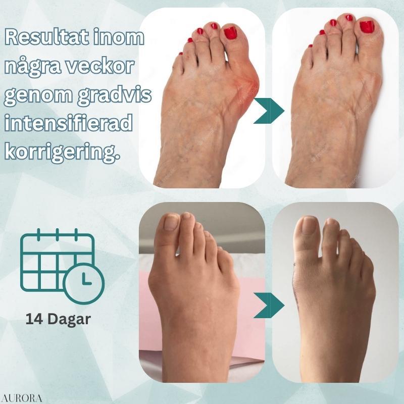Hallux Valgus Schiene: Sanfte Korrektur der Großzehe bei Fußfehlstellung.