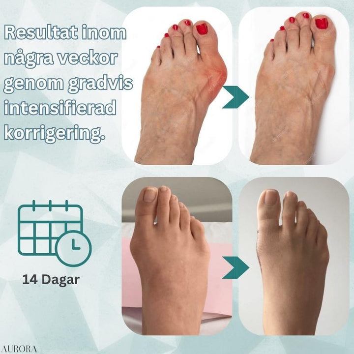 Hallux Valgus Schiene: Sanfte Korrektur der Großzehe bei Fußfehlstellung.