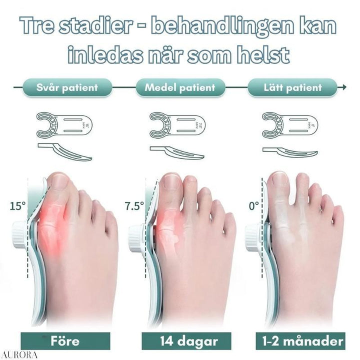 Verstellbare Hallux Valgus Orthese für individuelle Zehenkorrektur und Schmerzlinderung.