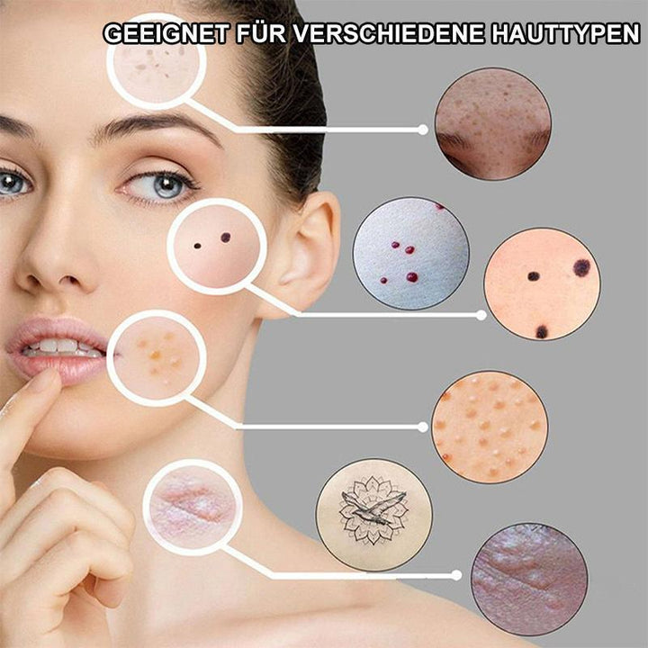 Handliches Hautpflegegerät zur effektiven Behandlung von Besenreisern und Rötungen. Verbessert Hautbild.