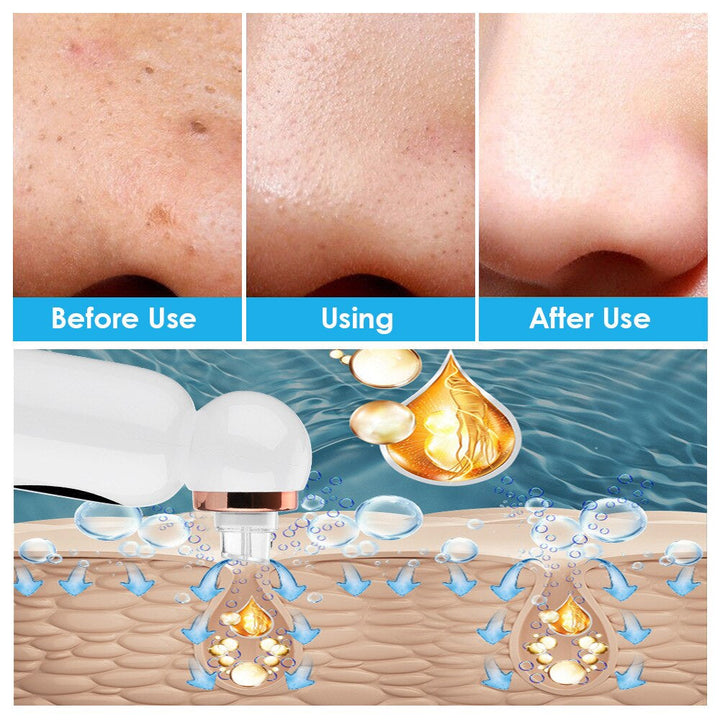 HydraGlow Hydrodermabrasion Porenreiniger für umfassende Hautpflege. Entfernt Mitesser, macht die Haut glatt & rein.