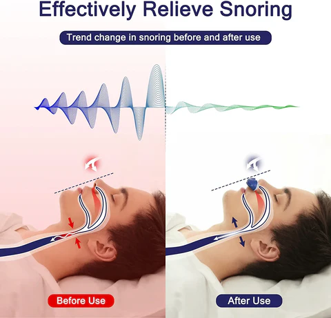 Detailansicht des Mikro-CPAP Schnarchstoppers, ein innovatives Anti-Schnarch-Gerät zur Linderung von Schlafapnoe.