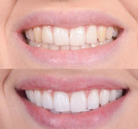 Komponenten des Zahnaufhellungssets: Gel und Schienen für effektives Zahnbleaching, Zahnpflege und Mundgesundheit.