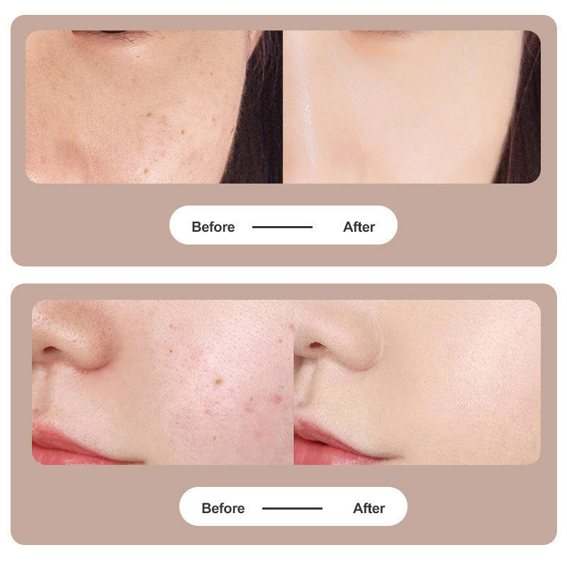 Der Plasma Pen Laser: Ideal für die Entfernung von Tattoos, Muttermalen und Hautflecken.