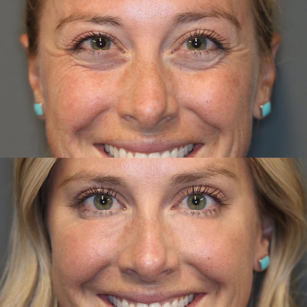 Frau trägt Retinol Augencreme Stick auf, reduziert Falten & Augenringe für glatte, straffe Haut.
