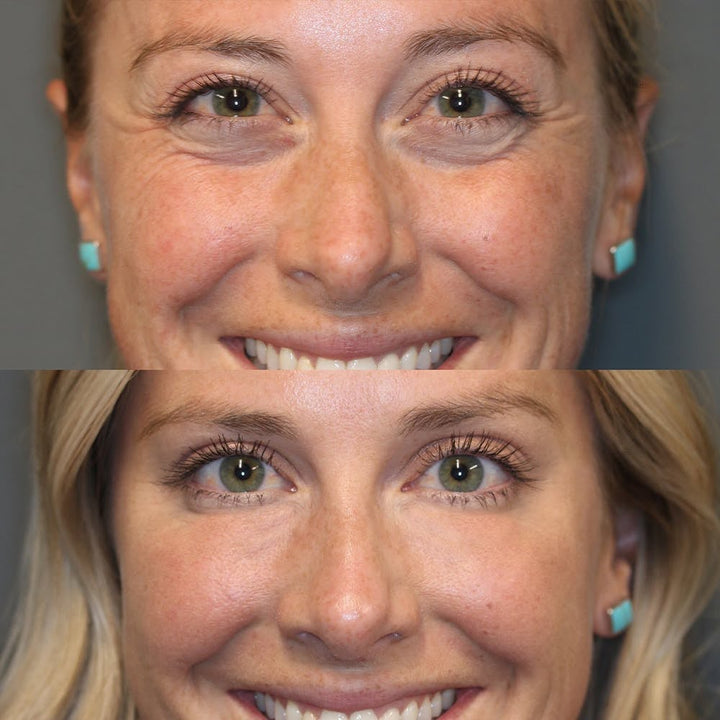 Frau trägt Retinol Augencreme Stick auf, reduziert Falten & Augenringe für glatte, straffe Haut.