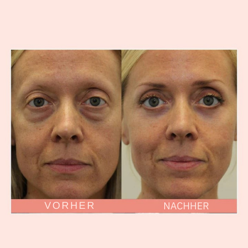 Aufhellender Retinol Augencreme Stick gegen dunkle Augenringe, für einen frischen & wachen Blick.