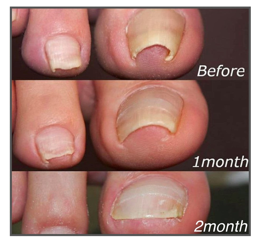 Korrektur-Pflaster für Zehennägel: Selbstklebende Hilfe zur Nagelpflege und schönen Pediküre.