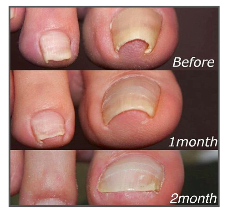 Korrektur-Pflaster für Zehennägel: Selbstklebende Hilfe zur Nagelpflege und schönen Pediküre.
