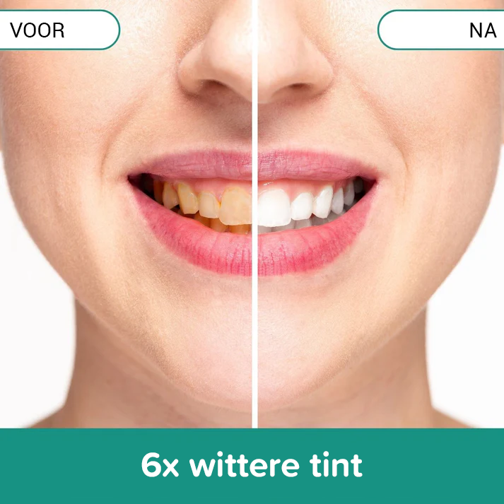 SmileFresh Gerät zur professionellen Zahnreinigung: Entfernt Plaque, Flecken, fördert weiße Zähne & Mundhygiene.