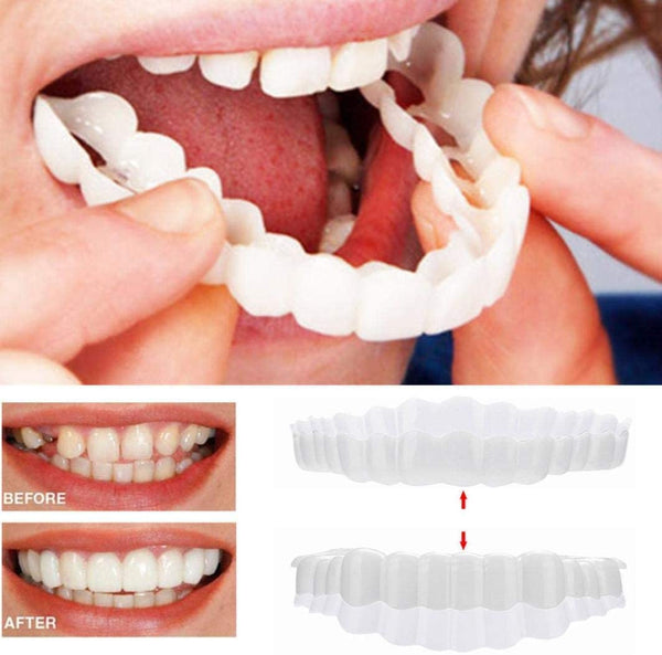 Ästhetische Sofortveneers für weiße, schöne Zähne. Perfektes Lächeln, stärkt Selbstbewusstsein. Ober- & Unterkiefer.