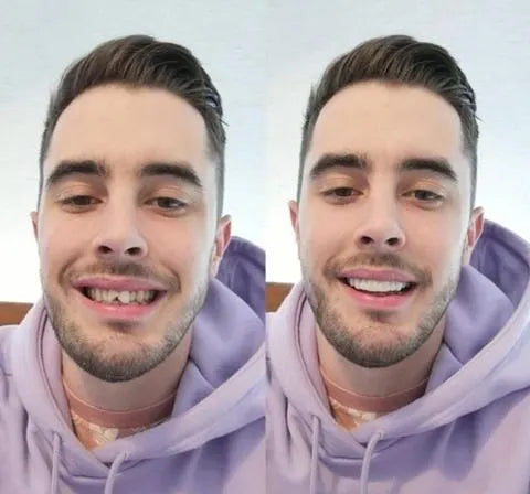 Hochwertige Sofort-Veneers für ein makelloses Lächeln. Zahnersatz & Zahnkosmetik für Ober- und Unterkiefer.