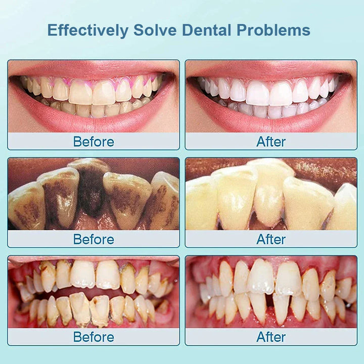 Dentalreiniger für zu Hause: Ultraschallzahnbürste für Zahnsteinentfernung & tägliche Zahnpflege.