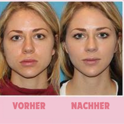 Kiefertrainer zur Aktivierung der Gesichtsmuskeln, für feste Konturen & reduzierte Faltenbildung.