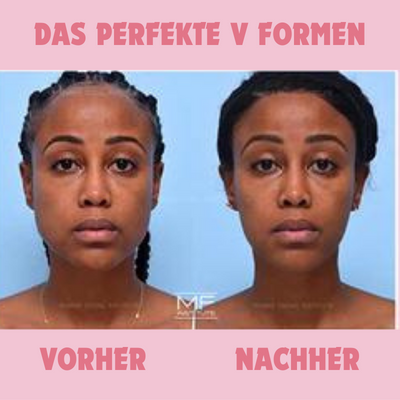 Premium Kiefertrainer Suction, verbessert die Kiefermuskulatur & sorgt für ein gestrafftes Erscheinungsbild.