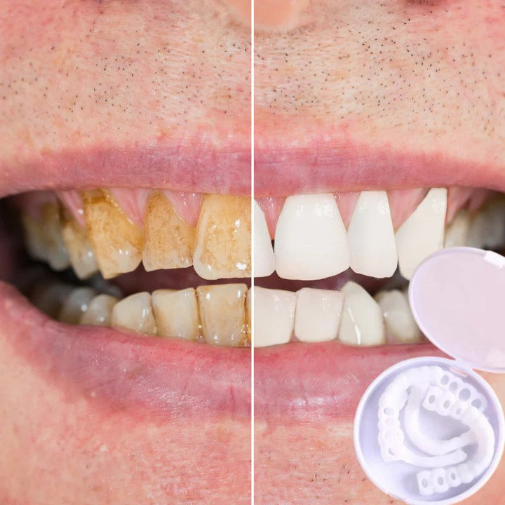 Flexibler kosmetischer Zahnersatz. Einfach aufsteckbare Veneers für ein sofortiges, ästhetisches weißes Lächeln.