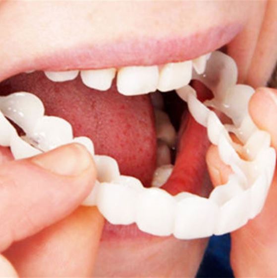 Klebstofffreie kosmetische Veneers: einfacher Zahnersatz für strahlend weiße Zähne. Sofort ein schönes Lächeln.