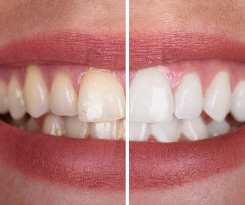 Sichtbare Zahnaufhellung mit diesem Unisex Gel. Effektive Fleckenentfernung für strahlend weiße Zähne.