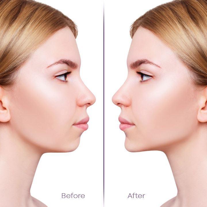 Transparentes Facelifting-Klebeband, make-up-freundlich, für jugendliches Aussehen ohne OP