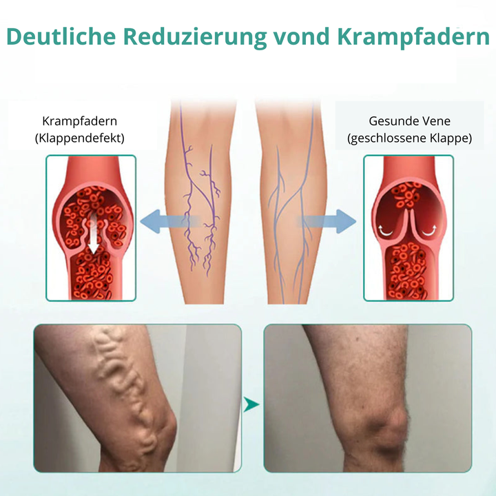 VenoLift Pflaster für spürbare Erleichterung von schweren Beinen, Krampfadern und Schwellungen.