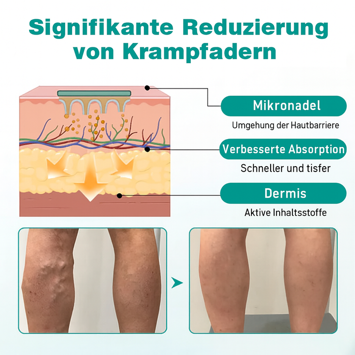 VenoLift Mikronadel-Pflaster Technologie für effektive Linderung von Venenbeschwerden und Krampfadern.