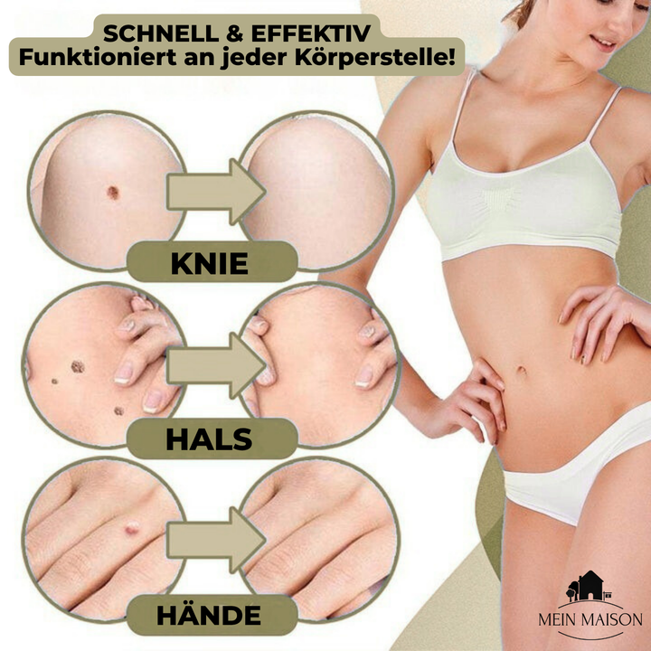 Der Warzenentferner für makellose Haut. Sichere Lösung bei Hautmakeln und zur Warzenentfernung zu Hause.