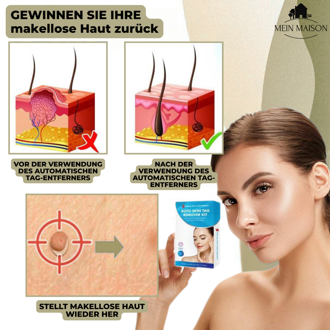 Verpackung des Warzenentferner & Muttermal Entferner Kits. Dermatologisch getestete Lösung für zu Hause.