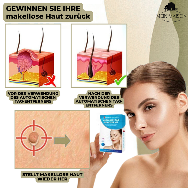Verpackung des Warzenentferner & Muttermal Entferner Kits. Dermatologisch getestete Lösung für zu Hause.