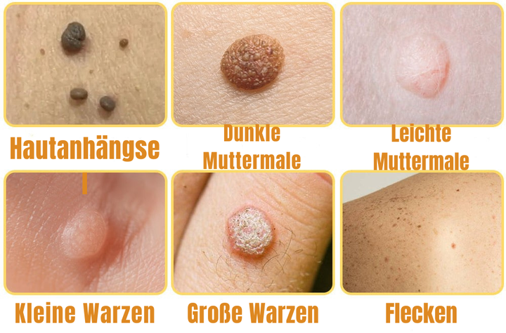 Effektives Warzenentferner Hautspray zur schnellen, schmerzfreien Pflege gegen Hautunreinheiten; für seidige Haut.